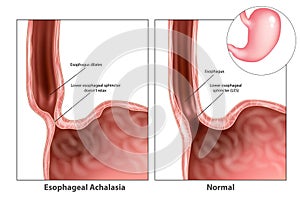 Esophageal achalasia, often called simple achalasia. photo